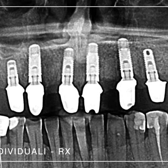 romedas, fatete dentare, dr Sorin Mihali, clinica dental concept by dr sorin mihali, implant dentar, implant zigomatic, all on 4, all on 6, cosmetica dentara, fatete duble