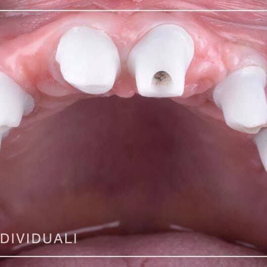 romedas, fatete dentare, dr Sorin Mihali, clinica dental concept by dr sorin mihali, implant dentar, implant zigomatic, all on 4, all on 6, cosmetica dentara, fatete duble