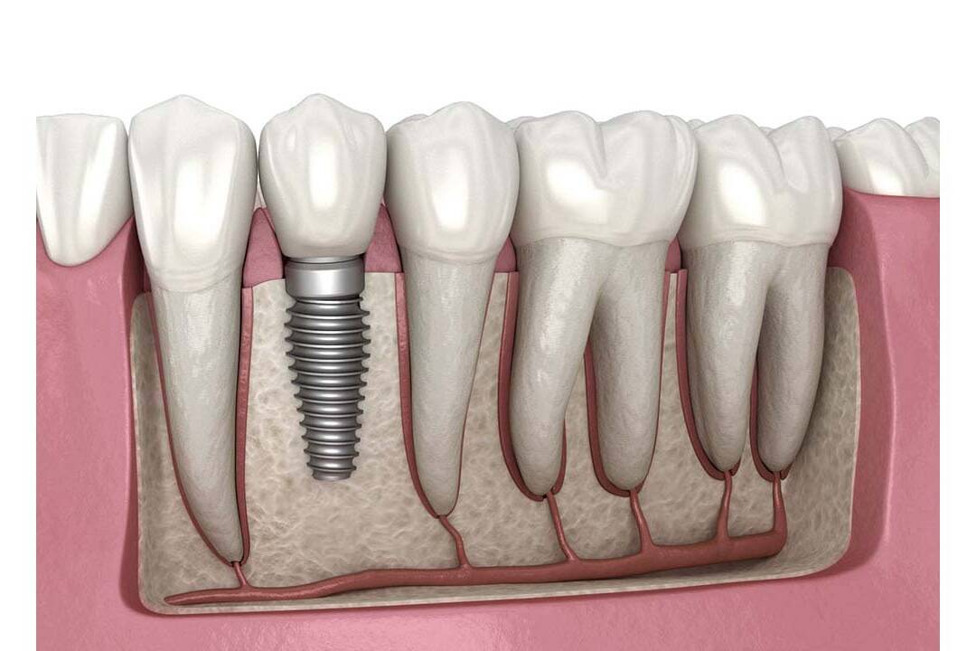implant dentar nou uai