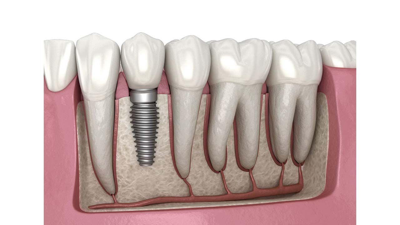 implant dentar nou